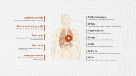 Multidisciplinary Approach to Diagnosis of IgG4-RD
