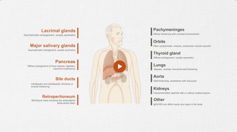 Multidisciplinary Approach to Diagnosis of IgG4-RD