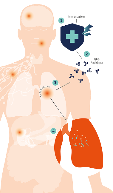 wie-igg4-rd-den-korper-beeinflusst-left-img